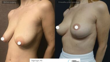 Breast Implant and Nose Job before after