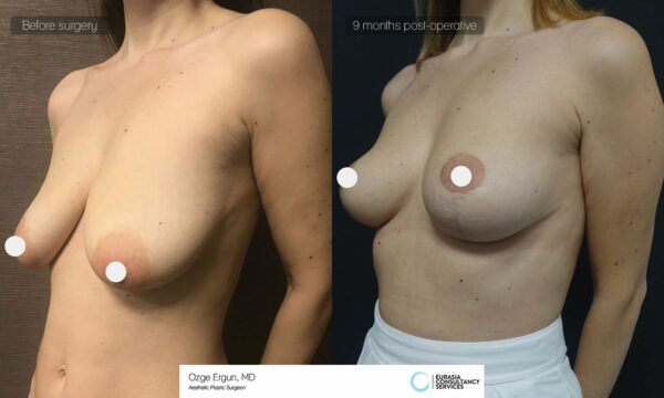 Breast Implant and Nose Job before after