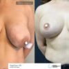 Breast Lifting / Reduction before after