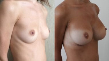 Breast Augmentation (Implant) before after