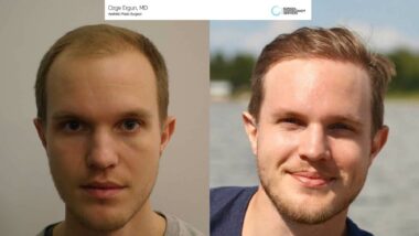 Before and After Hair Transplant