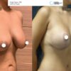 Breast Lift Reduction and Vaser Lipo Before After