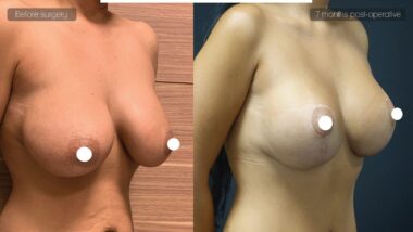 Breast Lift Reduction and Vaser Lipo Before After