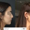 Rhinoplasty and Neck Lipo Before After