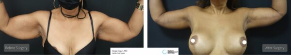 Arm Lift before after