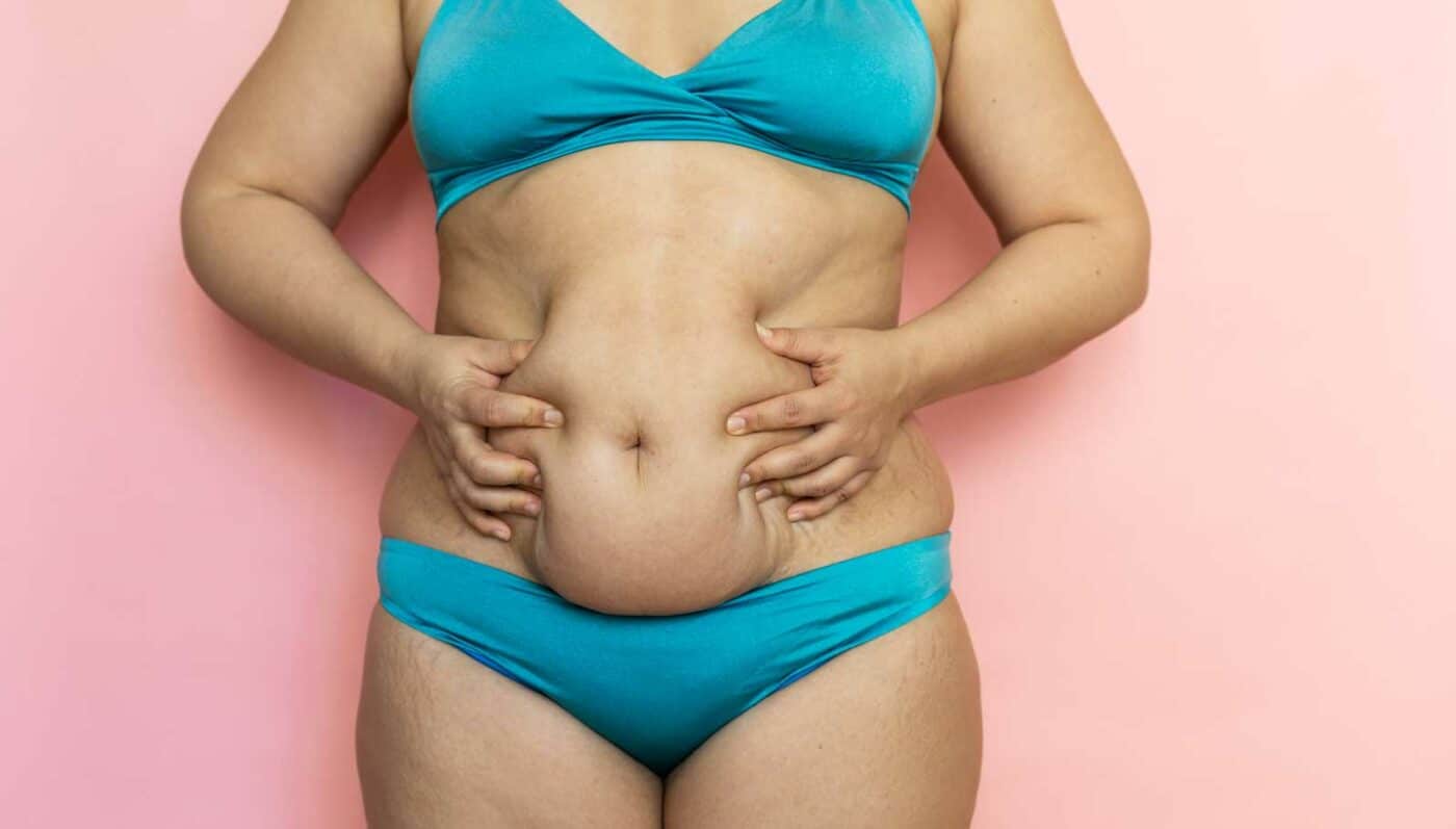 What Does a Tummy Tuck Involve?