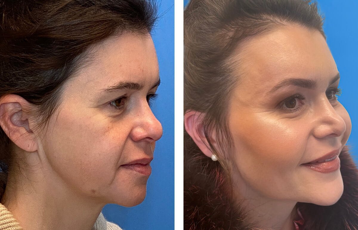 Cheek Implant Surgery - Best Medical Packages (€5.450)