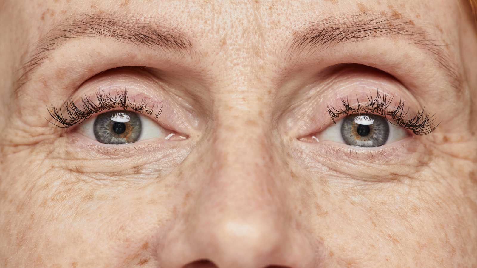 The Art of Combining Eyelid and Brow Lift Surgery Best Medical Packages