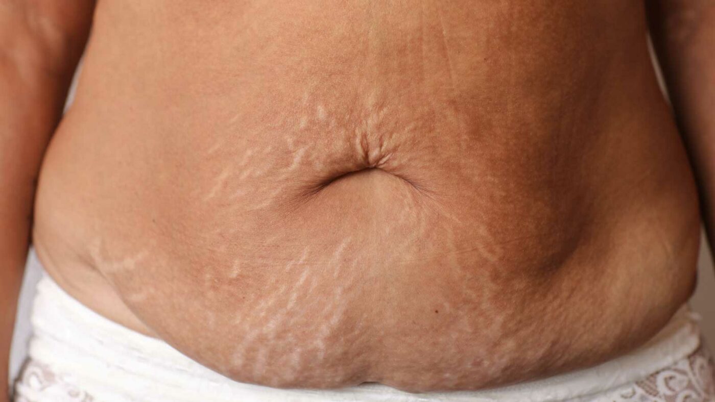 Excess Skin After Weight Loss